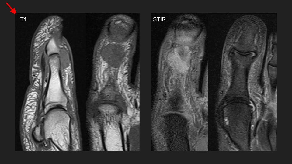 Figure 2 for case infectious or inflammatory disease ( RID3381 )